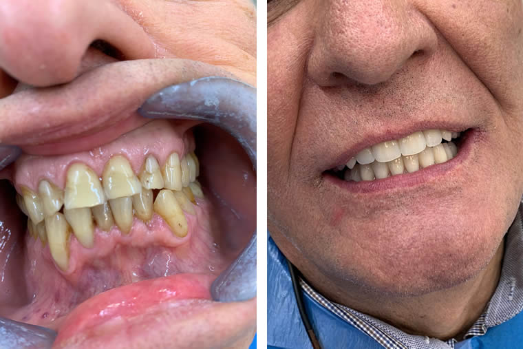 Caso Clinico Parodontite avanzata