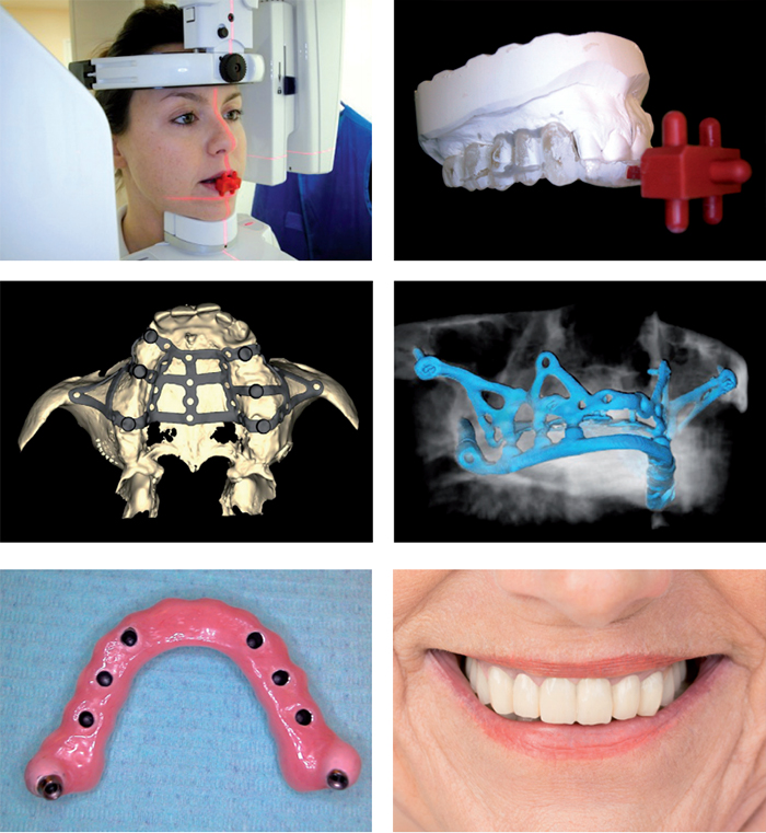 Implantologia a carico immediato Seregno