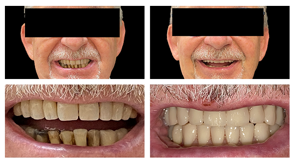 Caso Clinico Eagle Grid