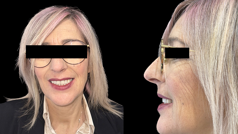 Casi clinici implantologia