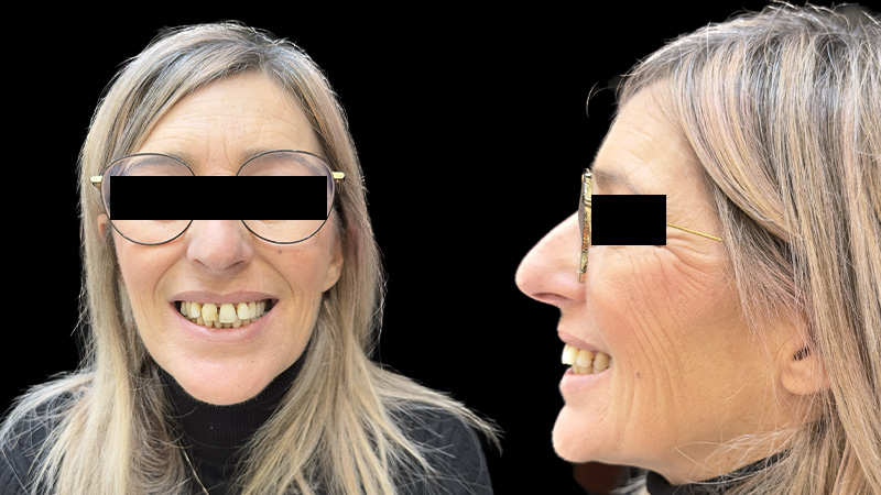 Casi clinici implantologia