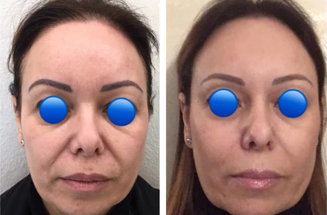 Trattamento combinato fortreleasing factor