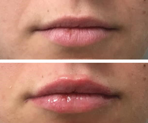 Filler con acido ialuronico Seregno