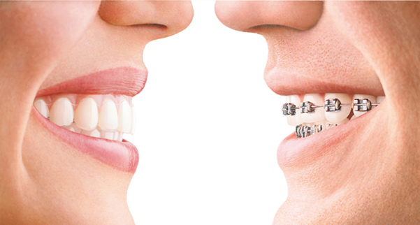Ortodonzia invisibile Seregno