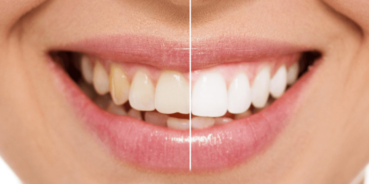 Sbiancamento denti Seregno